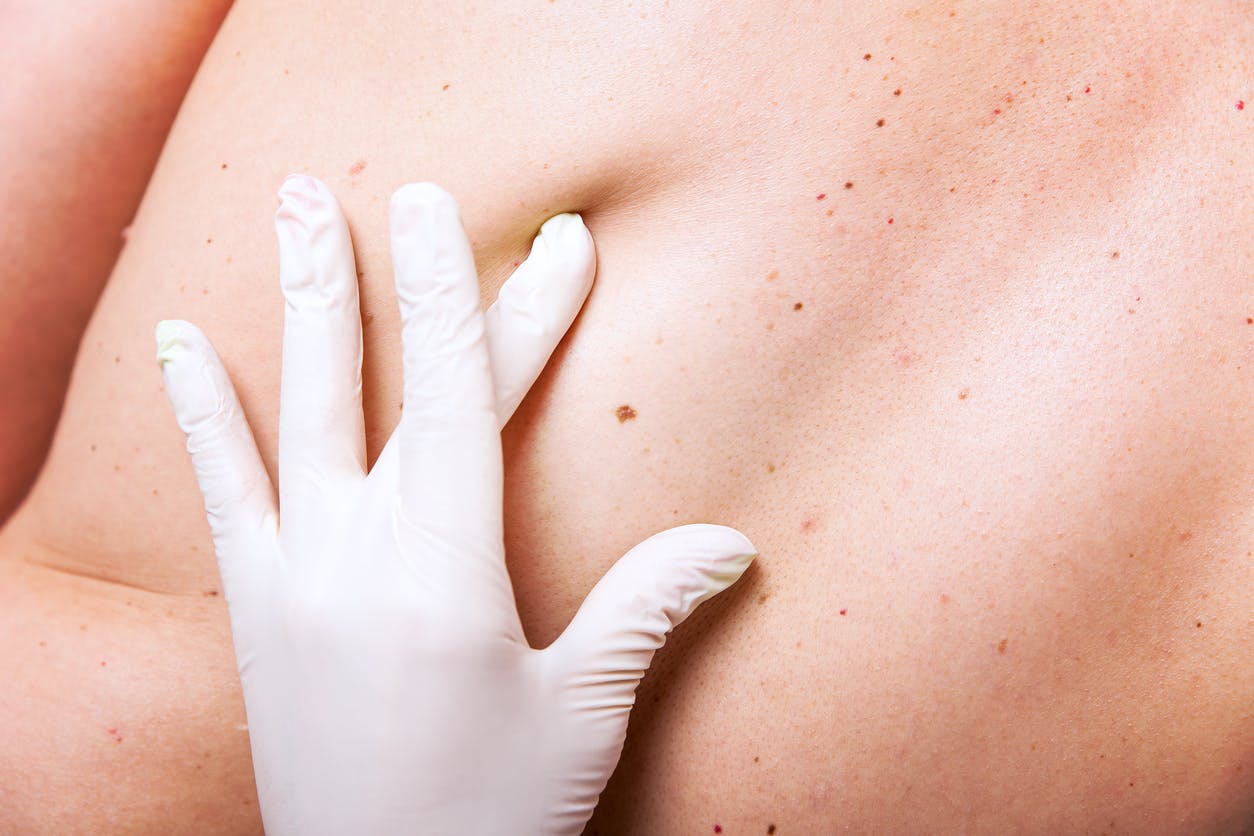 Boutons dans le dos : comment traiter ce type d’acné ?