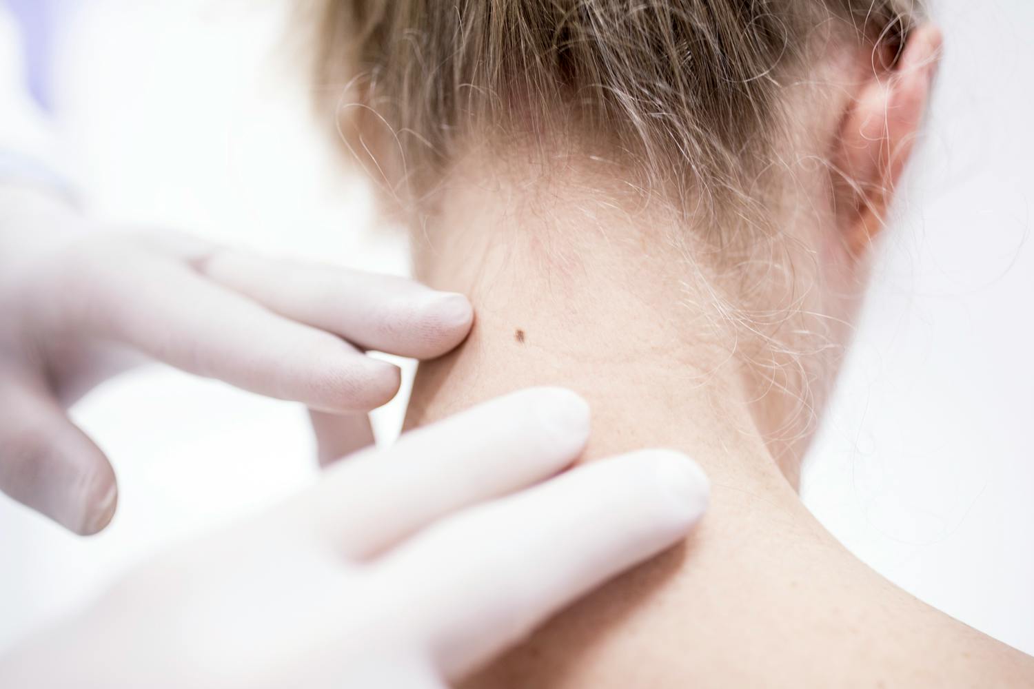 Un grain de beauté peut-il disparaître tout seul ?