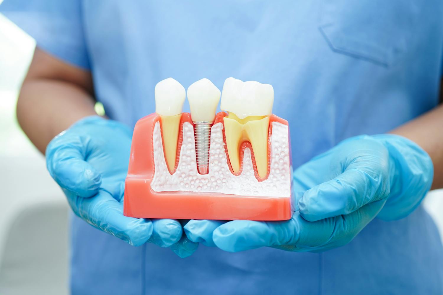 Implant dentaire : tout ce qu'il faut savoir avant l'opération