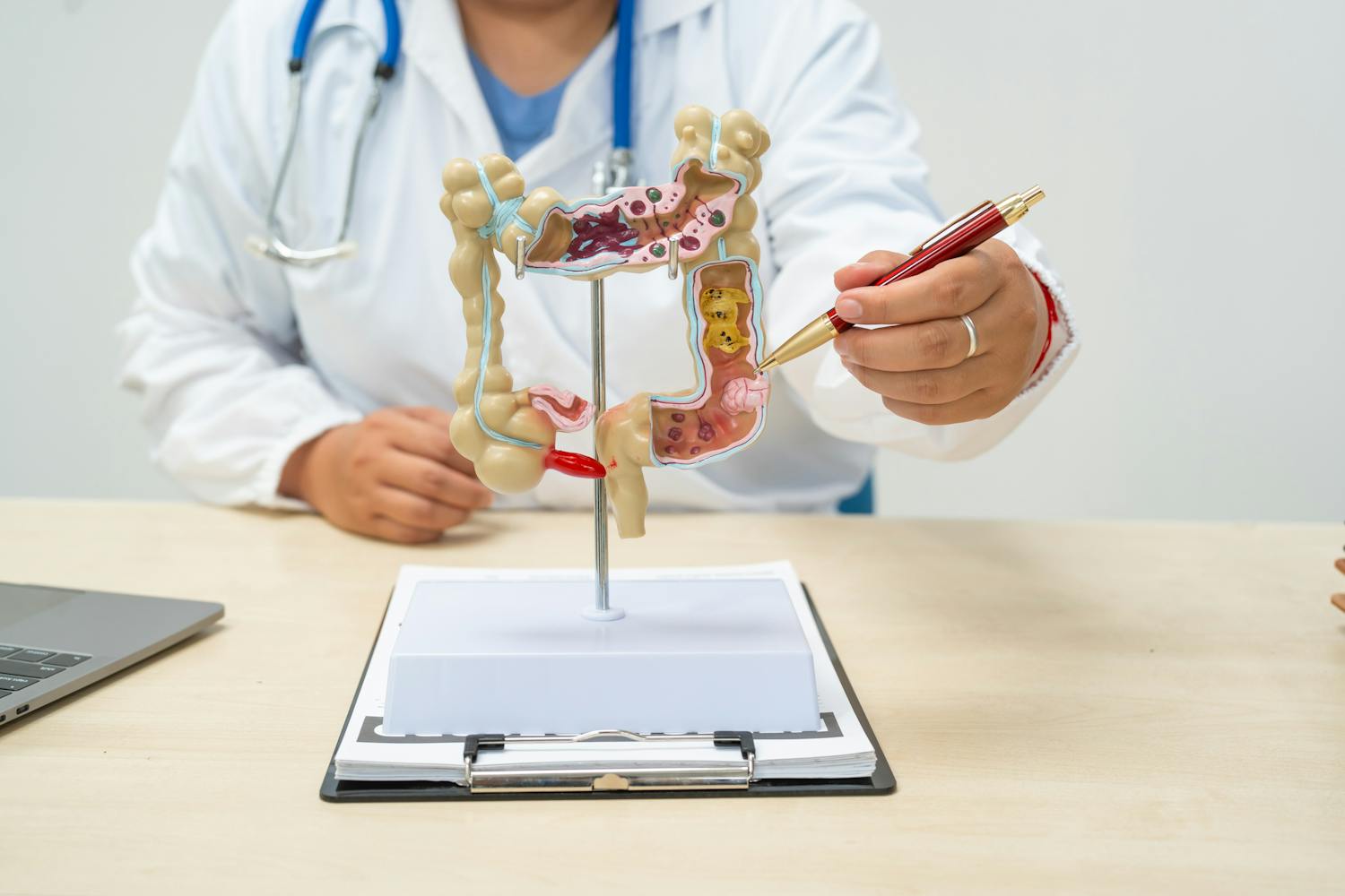 Quels sont les symptômes du cancer du côlon ?