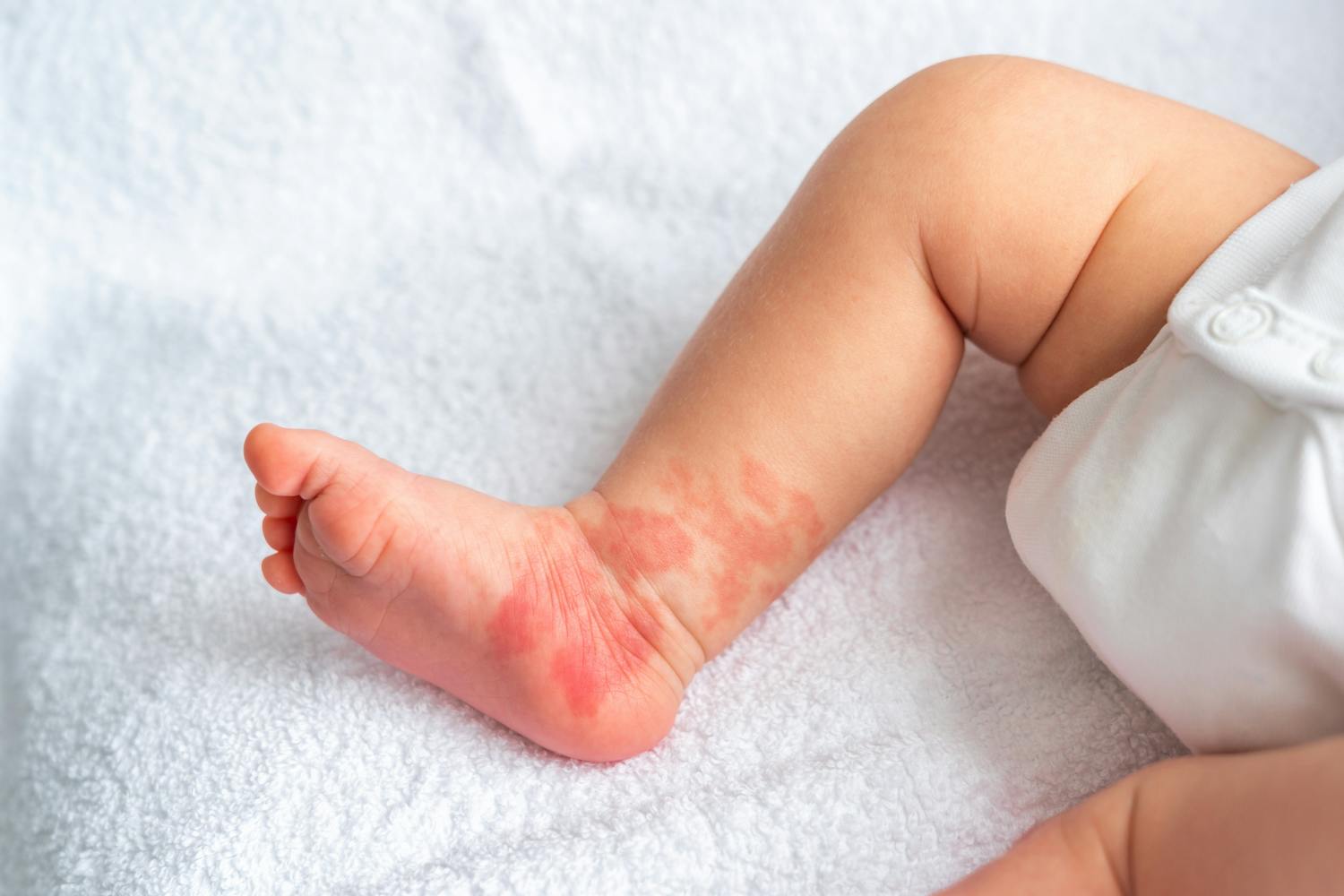 Angiome et hémangiome : quelle est cette tache sur mon bébé ?