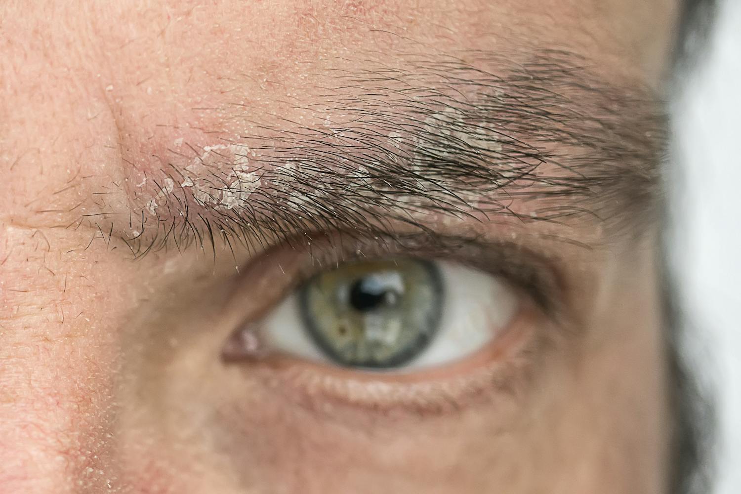 Pourquoi des pellicules apparaissent-elles sur vos sourcils ?
