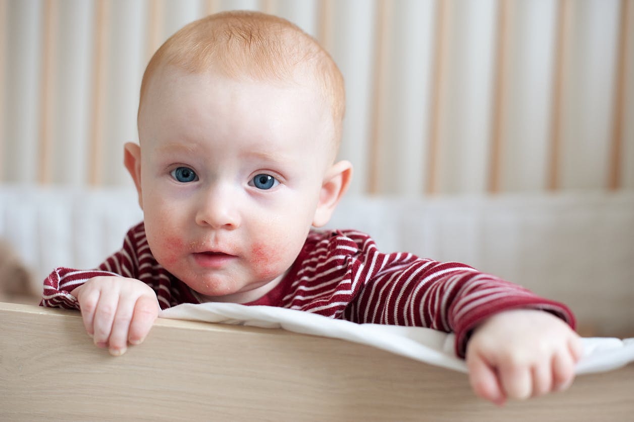 Comment réagir en cas d'allergie chez un bébé ?